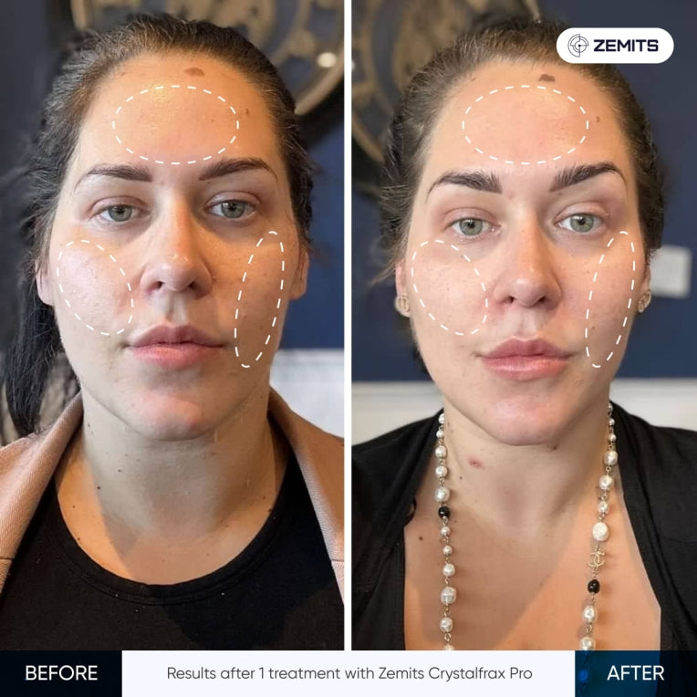 Zemits CrystalFrax PRO Fractional RF System
